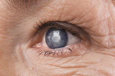 The image shows a close-up of an elderly person s eye with a noticeable cataract, emphasizing the texture and density of the lens clouding, which is typical for cataracts.